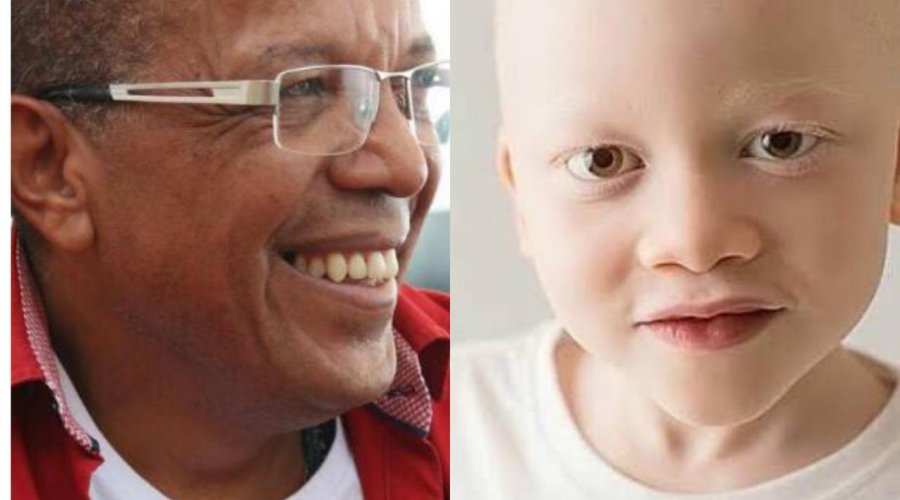 [Projeto que prioriza pessoas com albinismo em atendimento pelo SUS é sancionado pelo prefeito de Salvador]