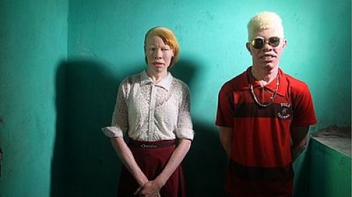 [Albinos passam a ter prioridade em marcação de consultas]