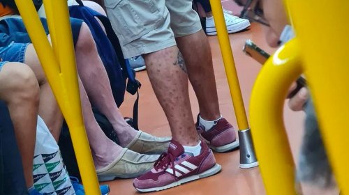 [Médico flagra homem infectado com varíola dos macacos em metrô de Madri]