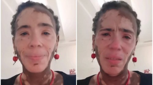 [Artesã com vitiligo denuncia preconceito em shopping de Salvador: 'Disse que eu tava contamina...]