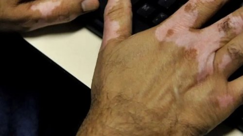 [Bahia segue fora da lista de estados que oferecem fototerapia para tratar vitiligo no SUS]