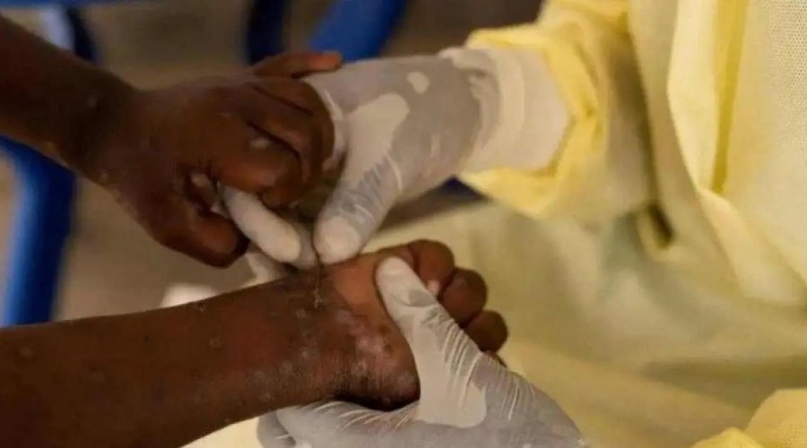 [Sesab reclassifica caso suspeito de Mpox na Bahia e confirma apenas um paciente no estado]