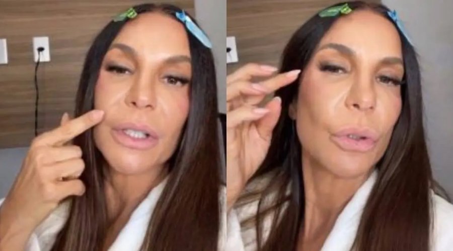 [Ivete Sangalo comenta recuperação após cirurgia no rosto: “Ainda sinto um pouco de dormência”]